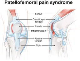 Patellofemoral pain syndrome diagram