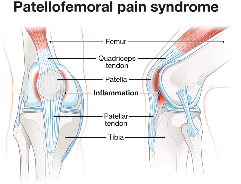 Patellofemoral pain syndrome diagram